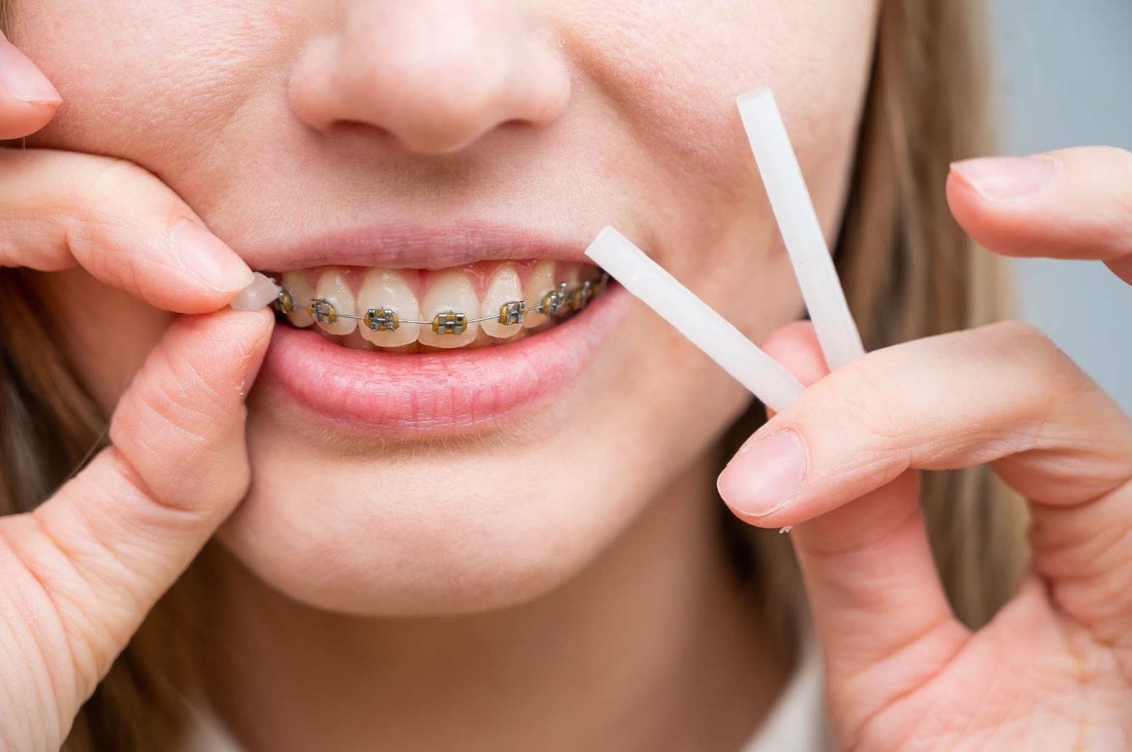 how to handle discomfort after getting braces