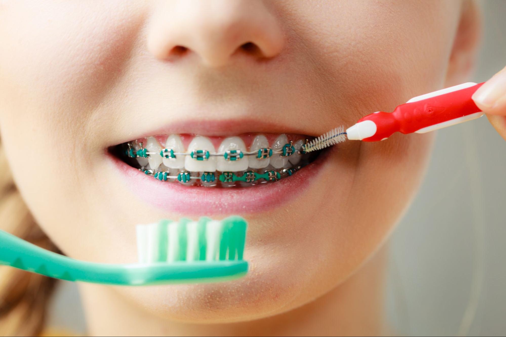oral hygiene with braces